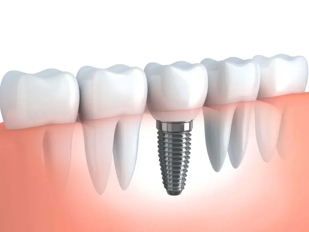 Zygomatic Dental Implants Cost Comparison – Affordable Prices Worldwide 164 Zygomatic Dental Implants Zygomatic Dental Implants Cost