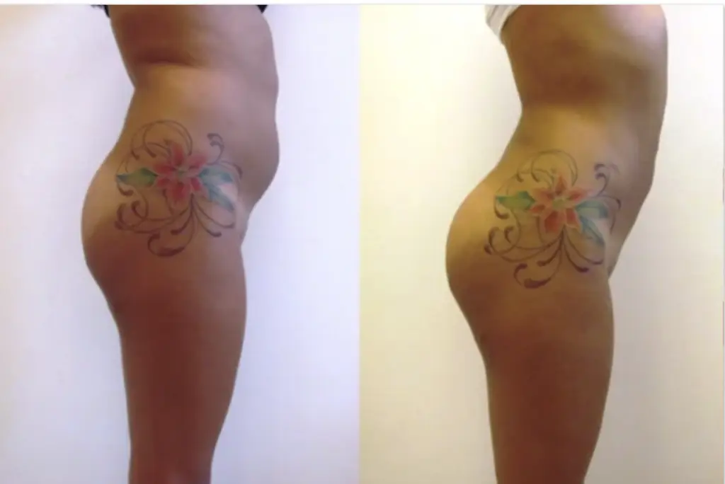 Affordable Liposuction at Cayra Clinic | Turkey 190 Affordable Liposuction Packages