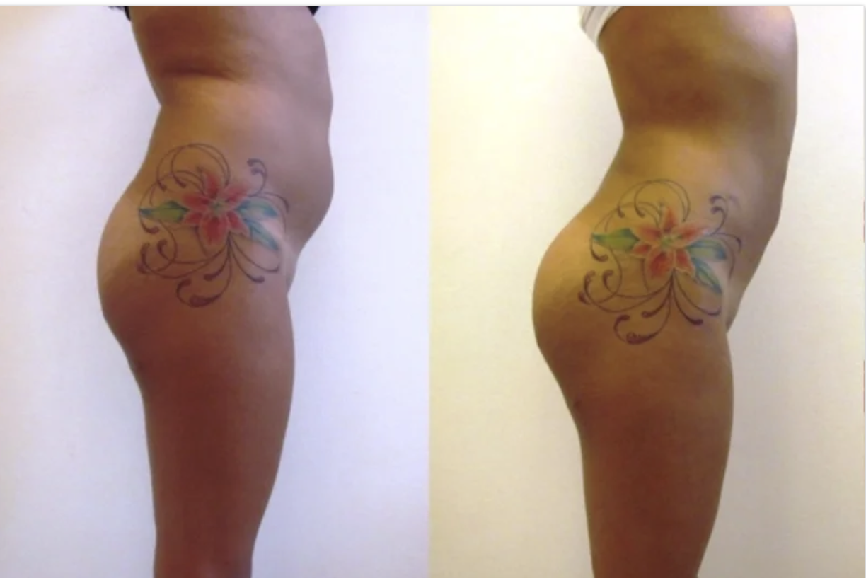 Affordable Liposuction Packages