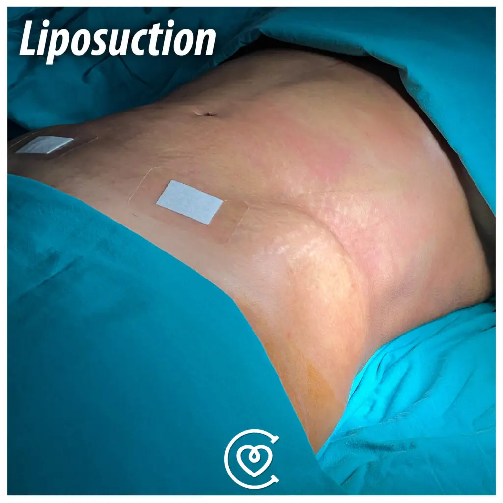 Best liposuction clinic