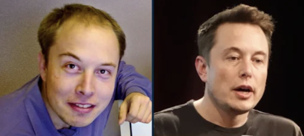 Elon Musk Hair Transplant Before and After Photo