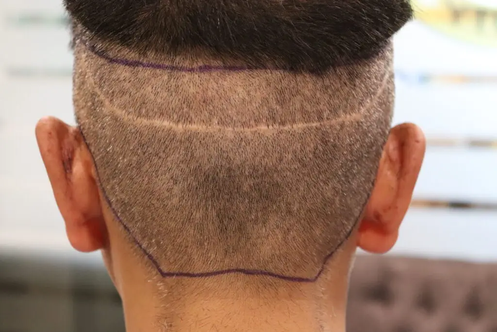 FUE vs. FUT Hair Transplant