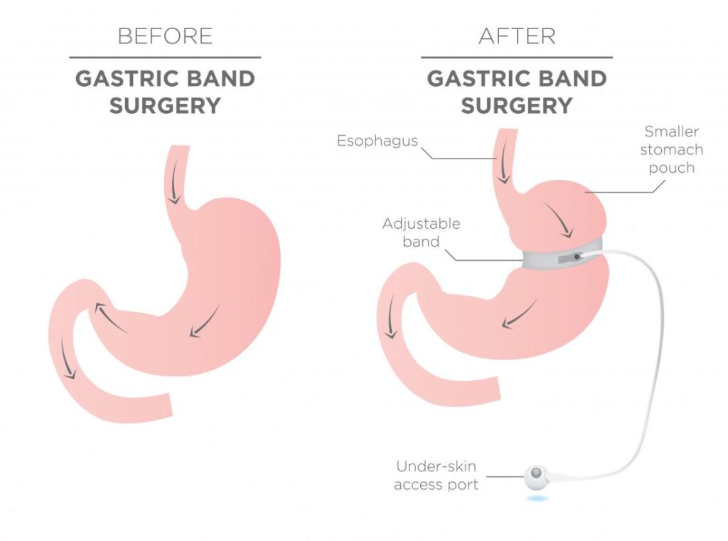 gastric band treatment