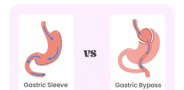 gastric sleeve vs gastric bypass