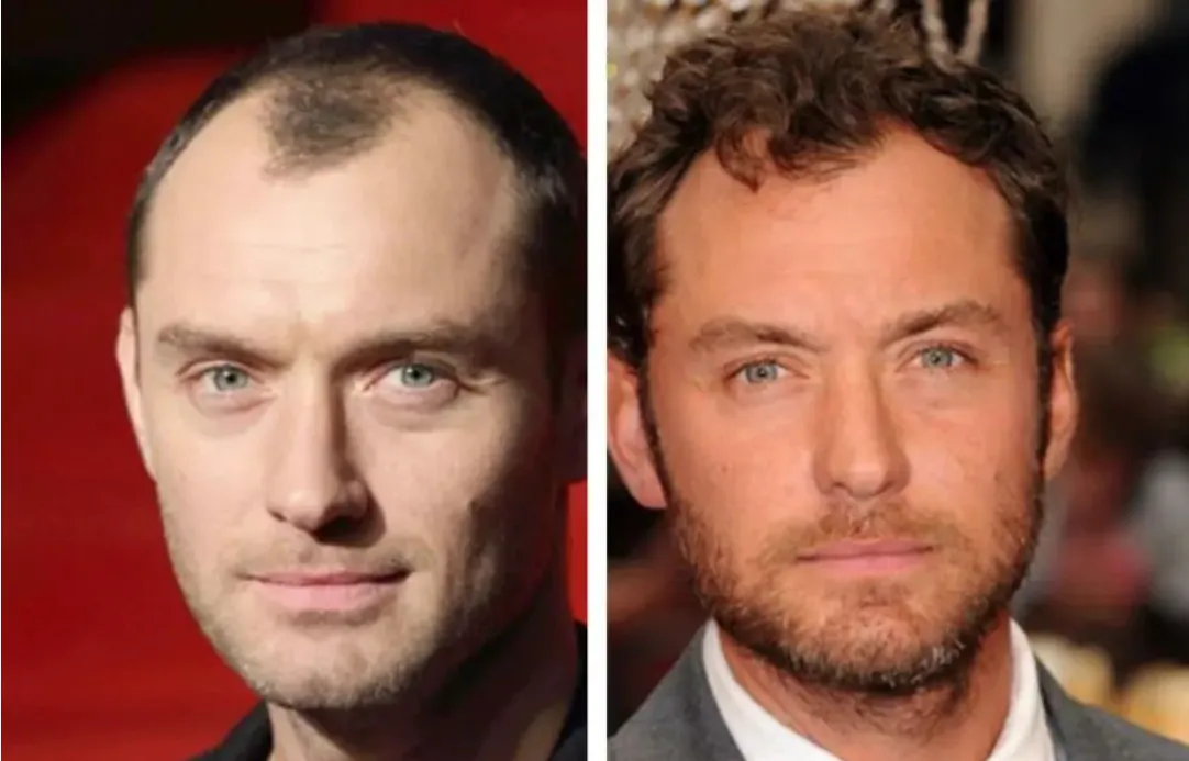 Jude Law Hair Transplant before and after Photos