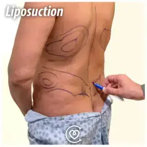 Liposuction cost in London