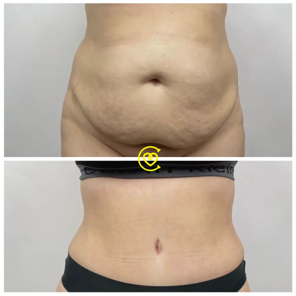 Understanding Liposuction Costs in the UK: A Complete Guide 188 Liposuction Cost UK