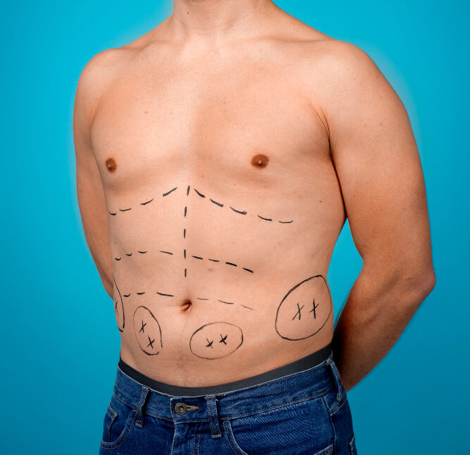 Male Tummy tuck