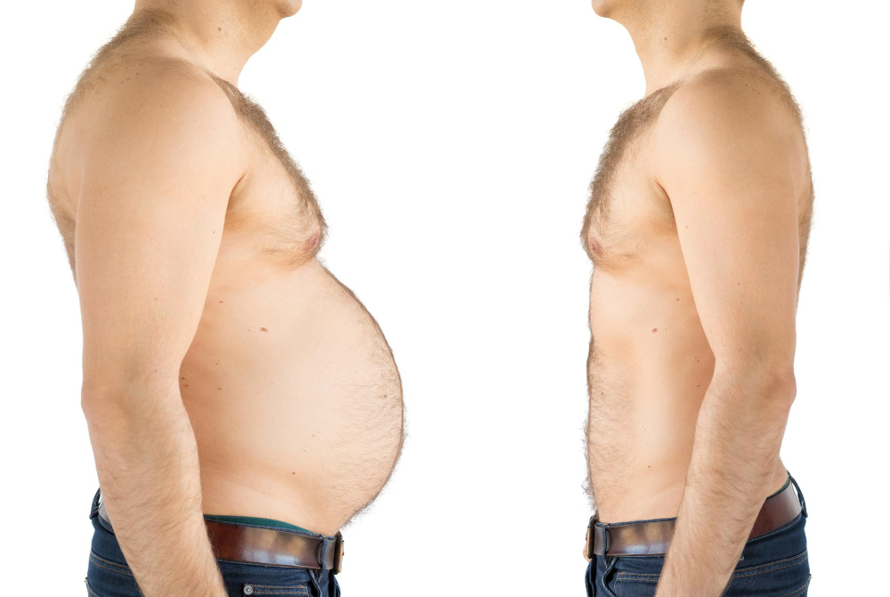 Men Tummy tuck before and after photo