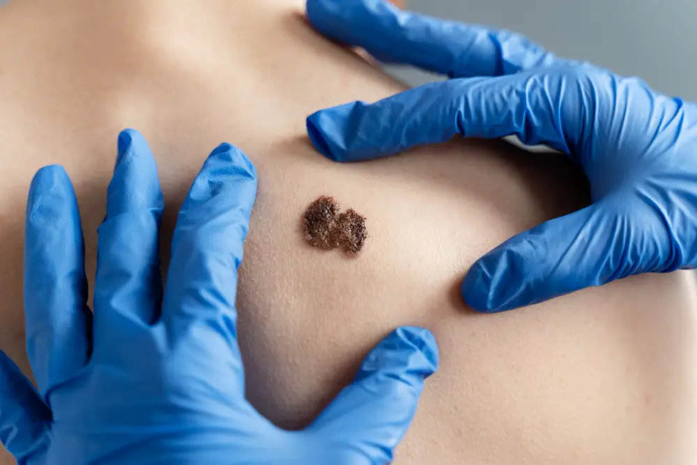 Exploring Mole Removal Options in Turkey 172 mole removal turkey