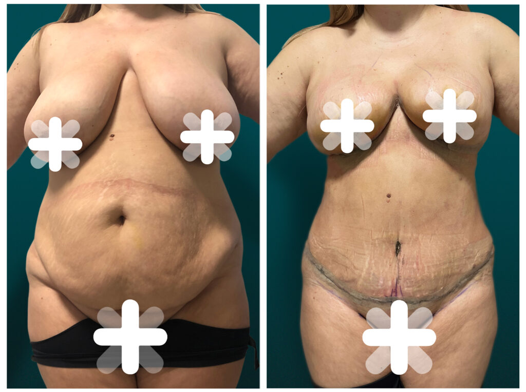 Tummy tuck before and after photo