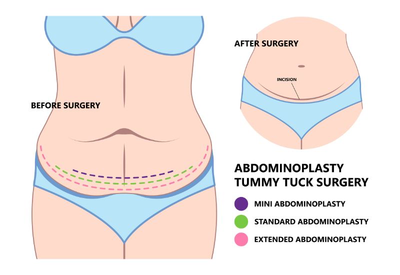 tummy tuck before and after​ scars