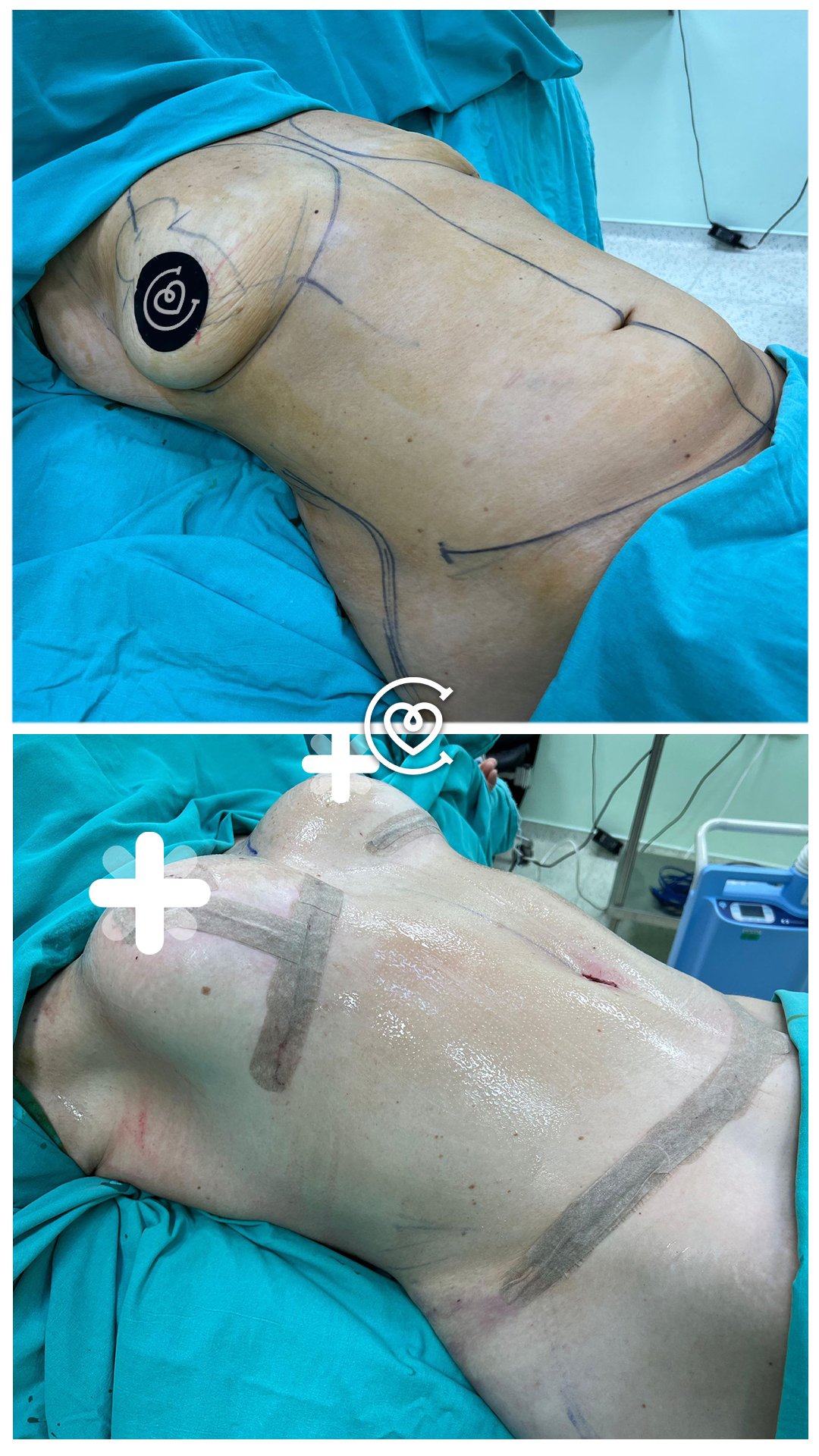 tummy tuck saggy skin on belly