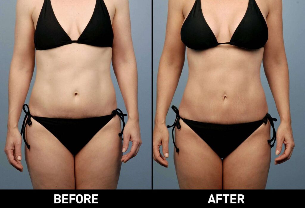 vaser liposuction before and after