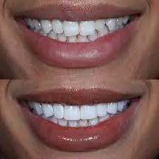 Composite Bonding in UK 128 Composite Bonding