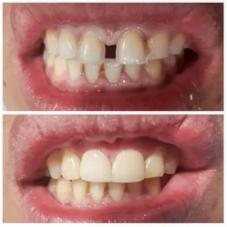 Dental Filling Before and After