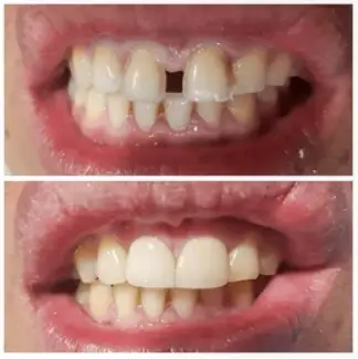 Obturation dentaire avant et après