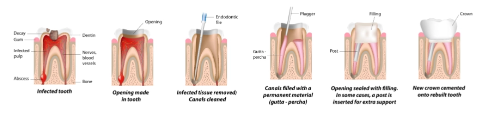 Dental filling procedures