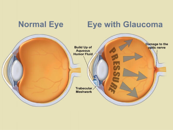 Glaucoma Treatment