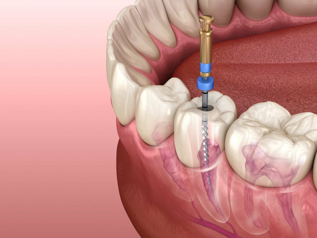 Root Canal Treatment 1 Root Canal Treatment In Turkey