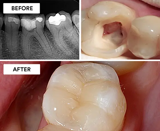 Root Canal Treatment Root Canal Procedure Root Canal Before And After Photos