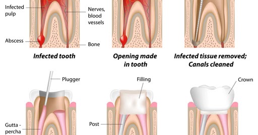 Root Canal Treatment 2 Root Canal Treatment Root Canal Procedure