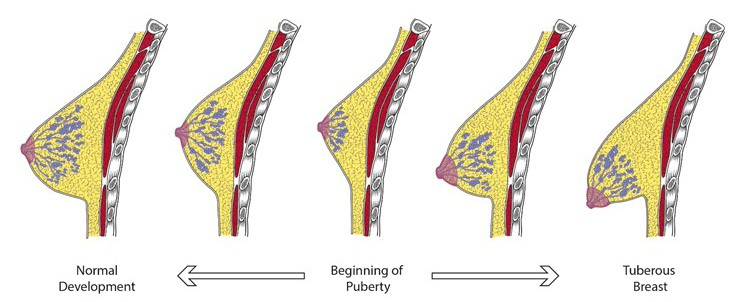 Treatment Options for Tuberous Breast