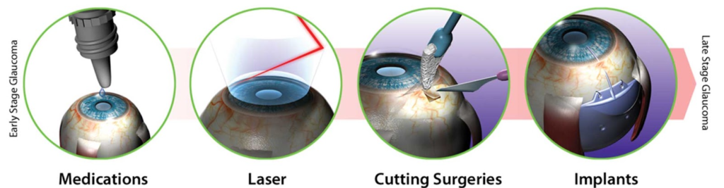 Types of Glaucoma Surgery Available