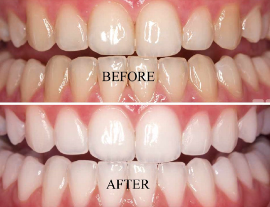 Types-of-teeth-whiteening