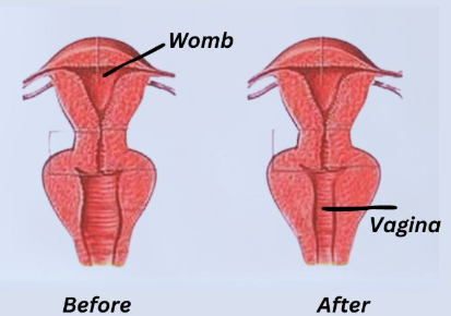 Benefits of HIFU Vaginal Rejuvenation