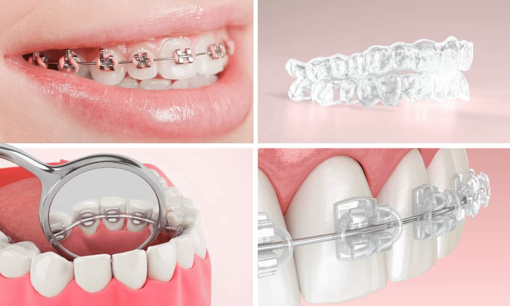 Braces Cost Braces Cost & Its Types