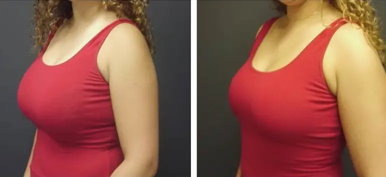 Breast Reduction before and after photos