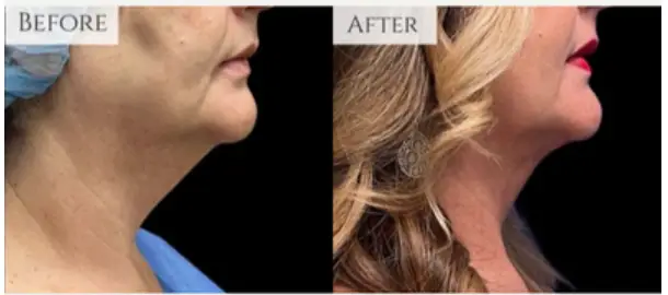 What to expect before and after liposuction 2025 2 Chin Liposuction