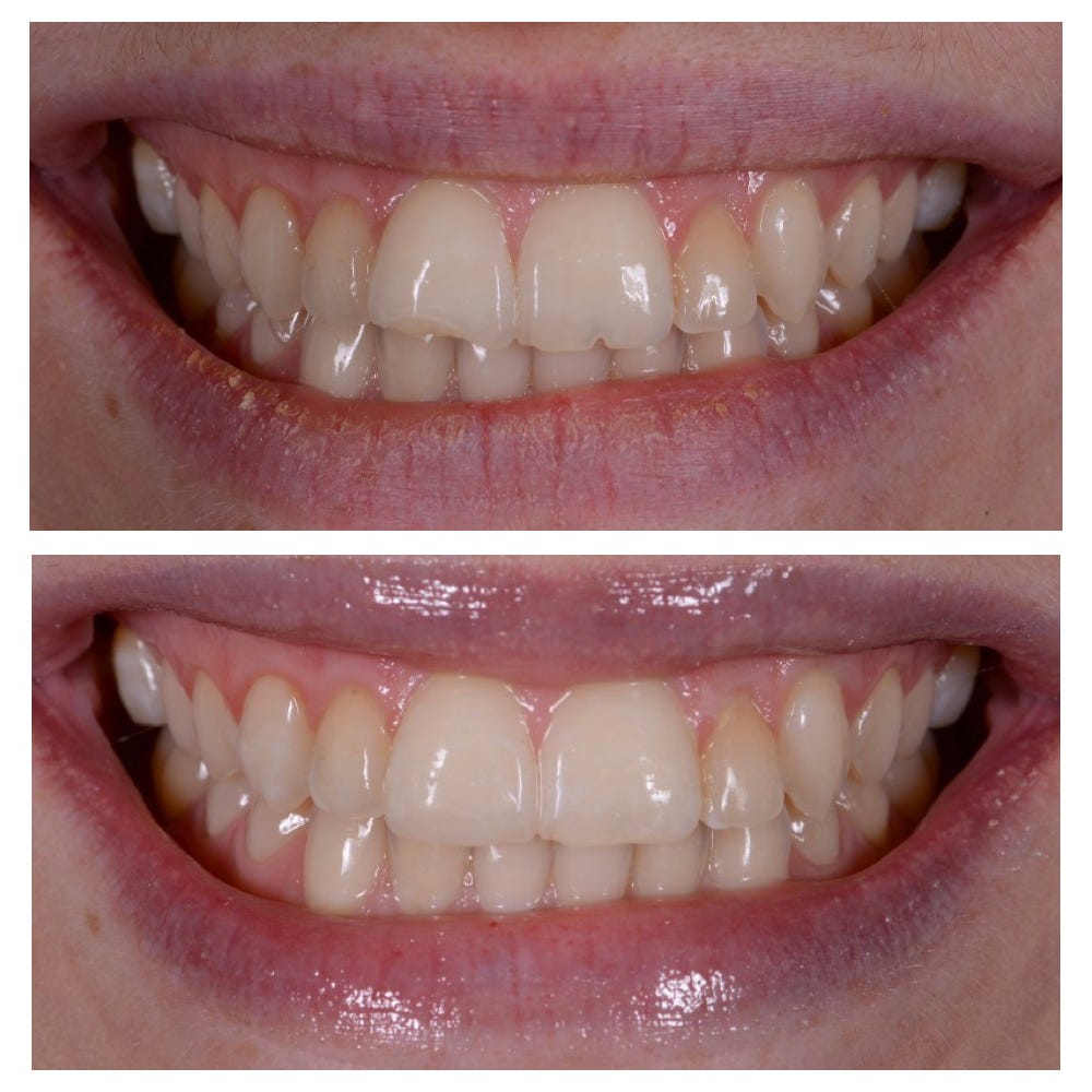 Restore Your Smile with Chipped Tooth Repair in Antalya 4 Chipped Tooth Repair Before and After photos