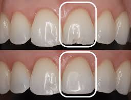 Restore Your Smile with Chipped Tooth Repair in Antalya 5 Chipped Tooth Repair Before and After photos