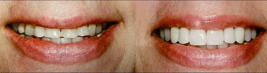 Chipped Tooth Repair - How to fix a chipped tooth and restore your smile