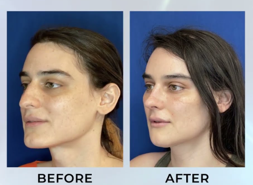 Facial Feminization Surgery