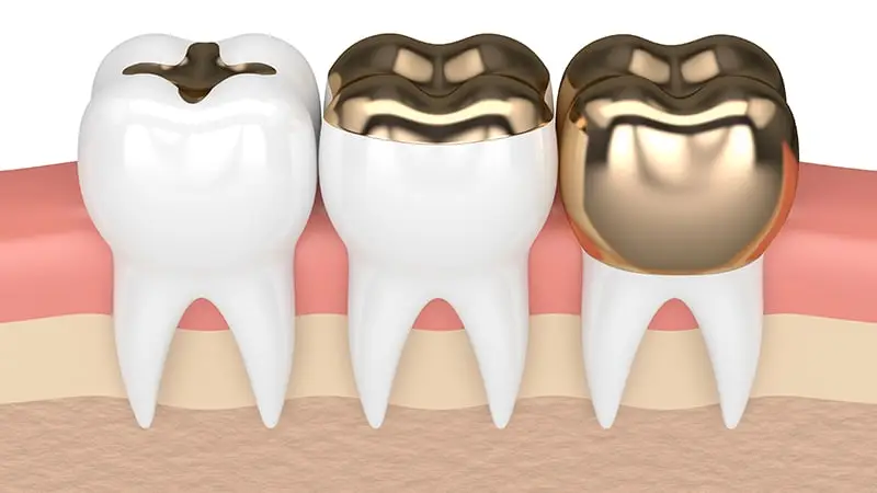 Gold Teeth: Benefits, Types & Cost in Antalya, Turkey 91 Gold Dental Treatment