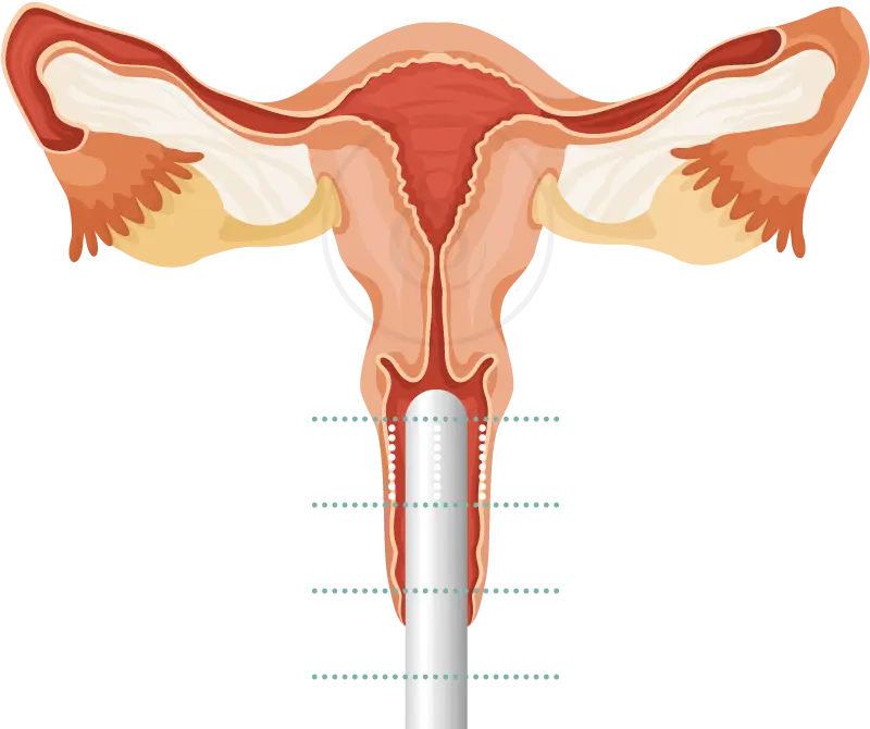 Restore Confidence with HIFU Vaginal Rejuvenation 77 HIFU Vaginal Rejuvenation in Turkey: Treatment & Benefits