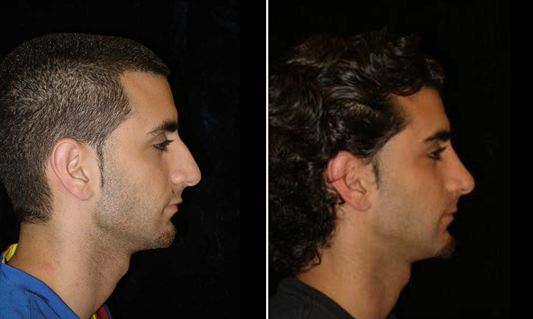 Middle Eastern Rhinoplasty Before And After