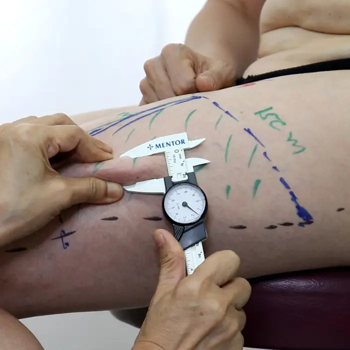 Phalloplasty Surgery in 2025 – Procedure, Cost & Results 73 Phalloplasty surgery