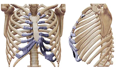 Rib Removal Surgery Risks and Safety 65 Rib Removal Surgery Risks and Safety