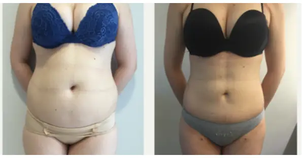 What to expect before and after liposuction 2025 1 Stomach Liposuction