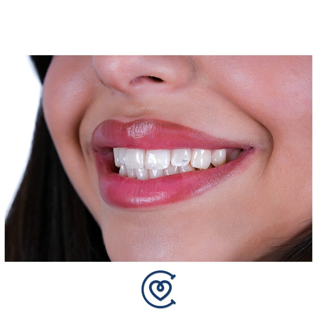 Gold Teeth: Benefits, Types & Cost in Antalya, Turkey 2 Silver Teeth Dental Treatment
Types of Dental Treatments