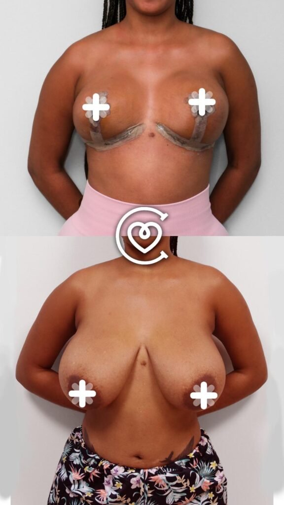 Breast reduction Turkey reviews