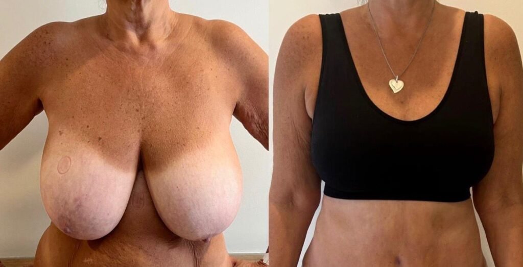 Breast reduction Turkey Before After