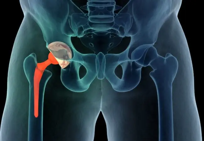 Affordable Hip Replacement Abroad 75 Affordable Hip Replacement Abroad