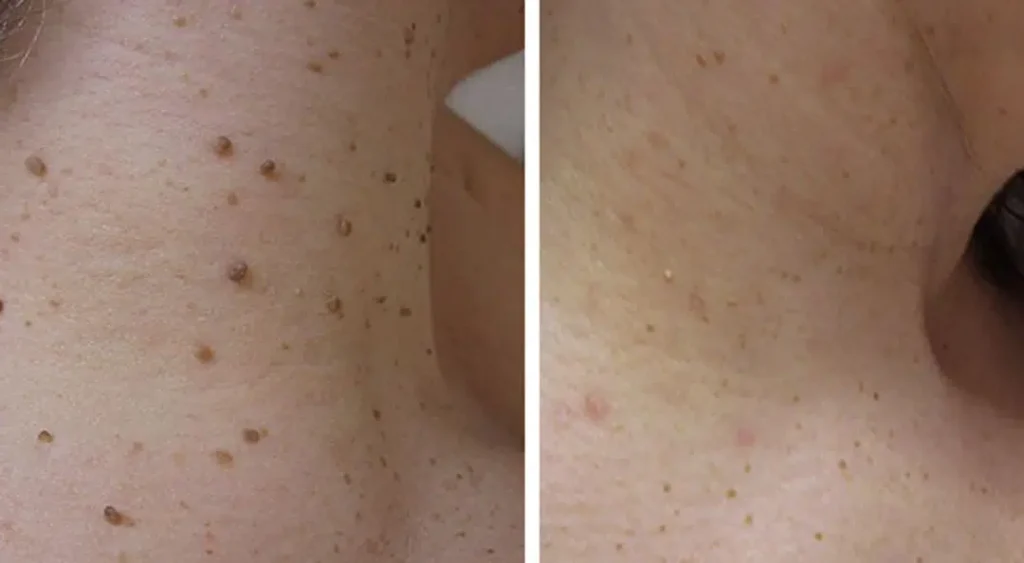skin tag removal before and after photos