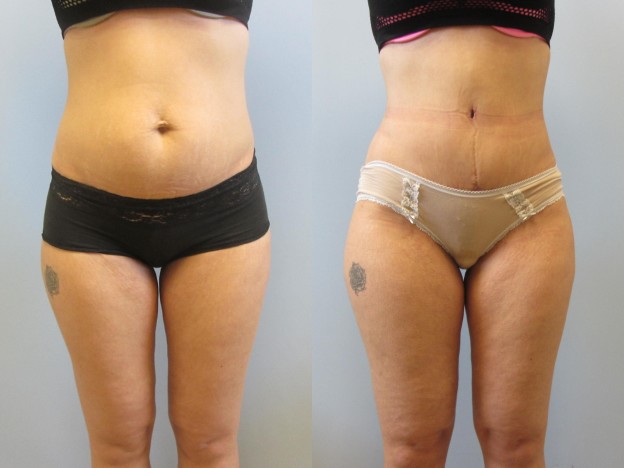 Mini Tummy Tuck Surgery