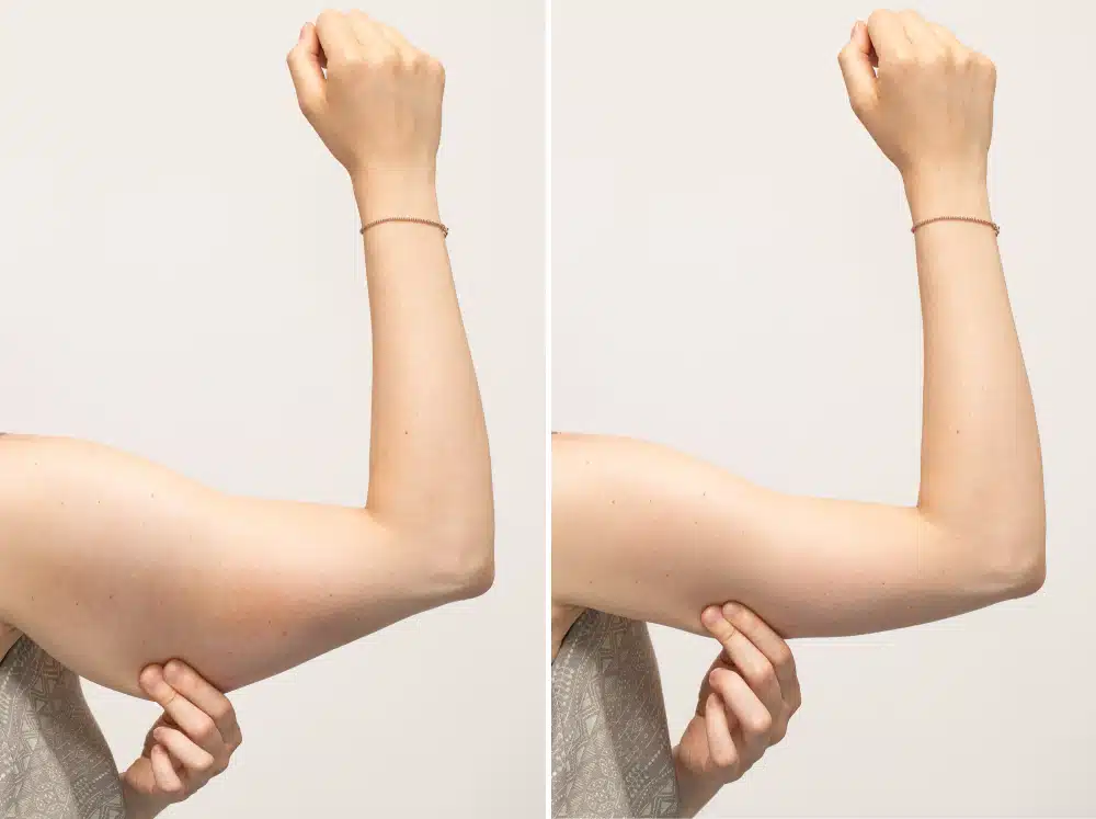 Arm Liposuction